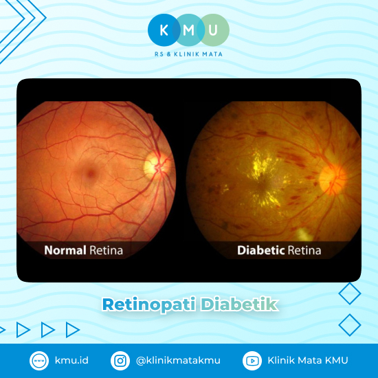 Retinopati Diabetik - Penyakit Mata pada Lansia