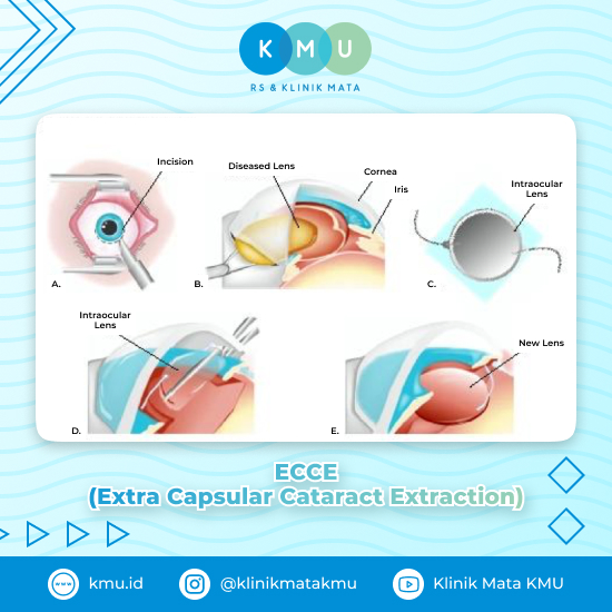 ECCE (Extra Capsular Cataract Extraction) - Teknologi Operasi Katarak