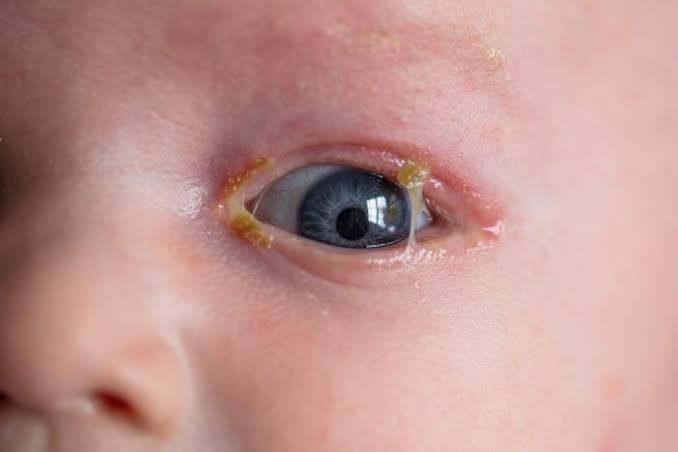Infeksi gonore pada mata bayi