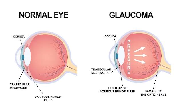 Gambar mata Glaukoma