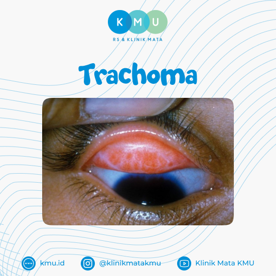 Kondisi Trachoma Dapat Dicegah Dengan Cuci Tangan