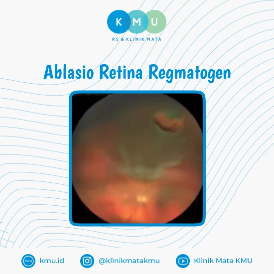 Ablasio Retina Regmatogen