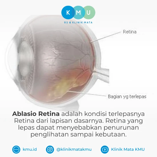 Pengertian Ablasio Retina