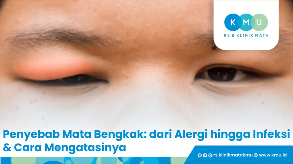 Penyebab Mata Bengkak: dari Alergi hingga Infeksi & Cara Mengatasinya