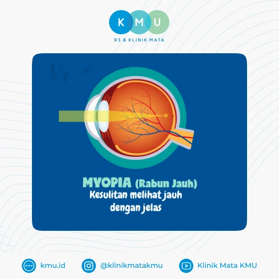 Myopia - Solusi Bebas Kacamata
