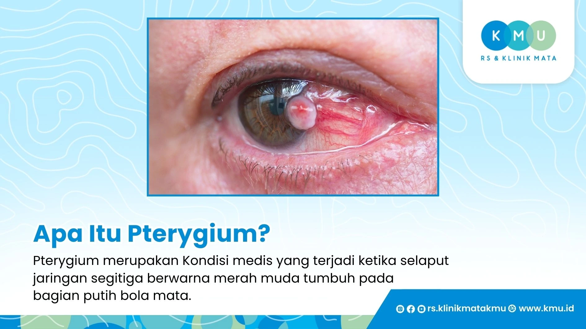 Pengertian Pterygium