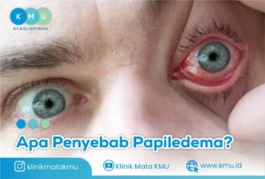 Papiledema