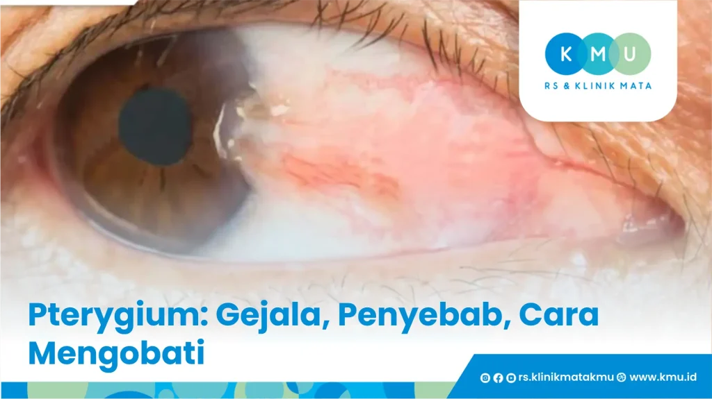 Pterygium: Gejala, Penyebab, Cara Mengobati