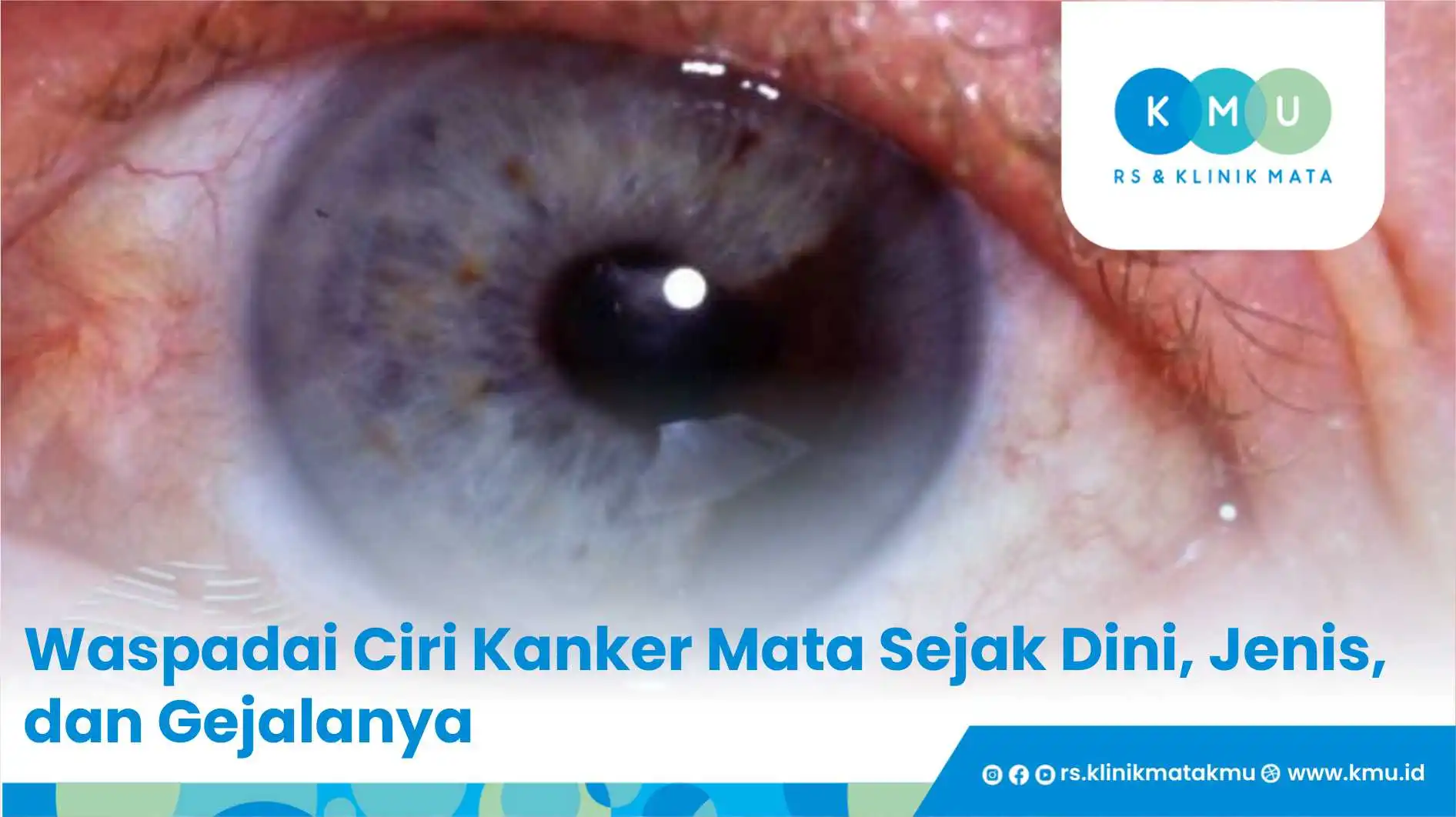 Waspadai Ciri Kanker Mata Sejak Dini, Jenis, dan Gejalanya