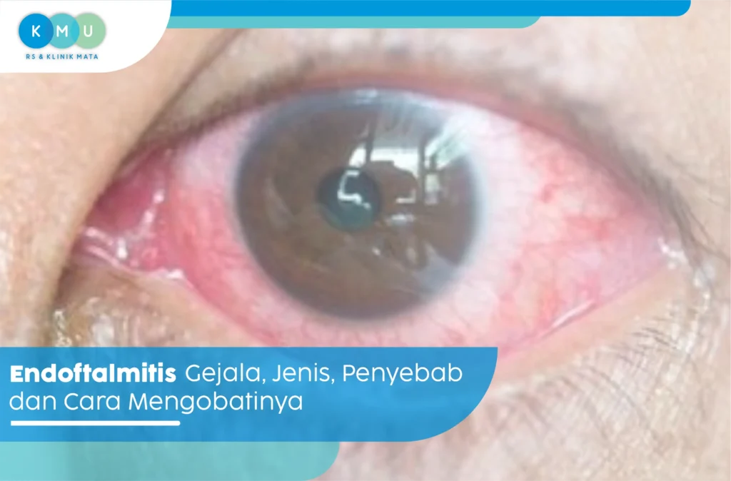 endoftalmitis