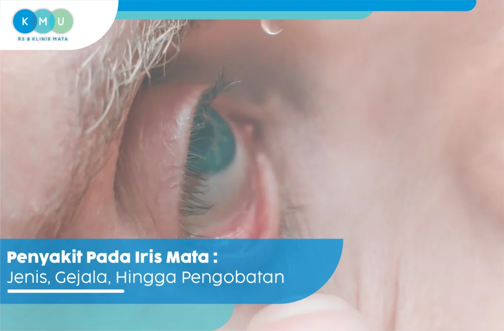 penyakit pada iris mata