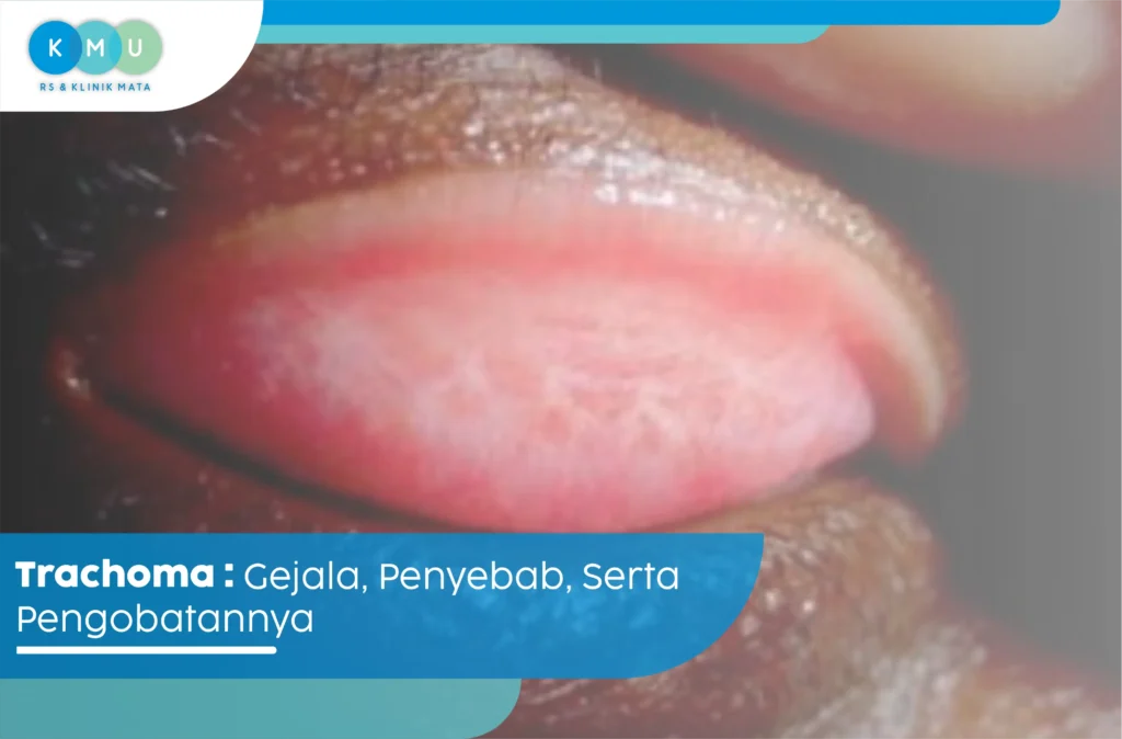 Trachoma