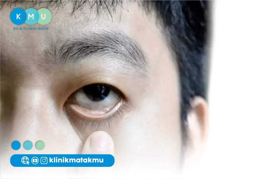 Gangguan kelopak mata