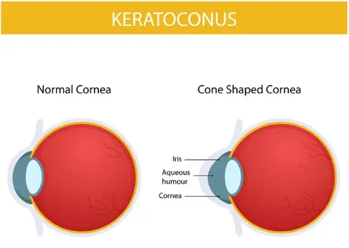 Keratokonus