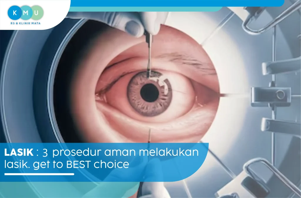 Lasik