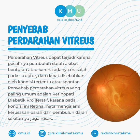 PENYEBAB PERDARAHAN VITREUS Badan Kaca