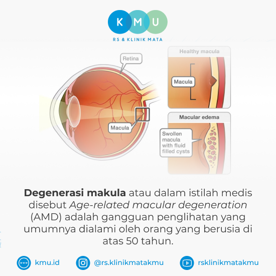 Pengertian Degenerasi Makula - Pengobatan Degenerasi Makula