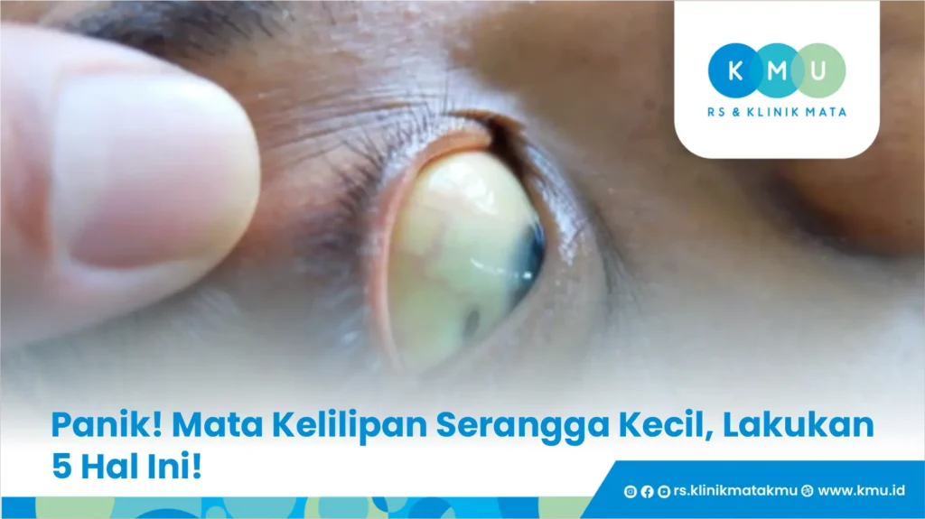 Panik! Mata Kelilipan Serangga Kecil, Lakukan 5 Hal Ini!