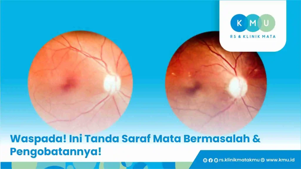 Waspada! Ini Tanda Saraf Mata Bermasalah & Pengobatannya!