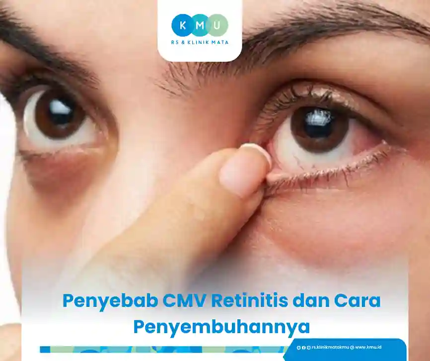 Apa Itu CMV Retinitis?