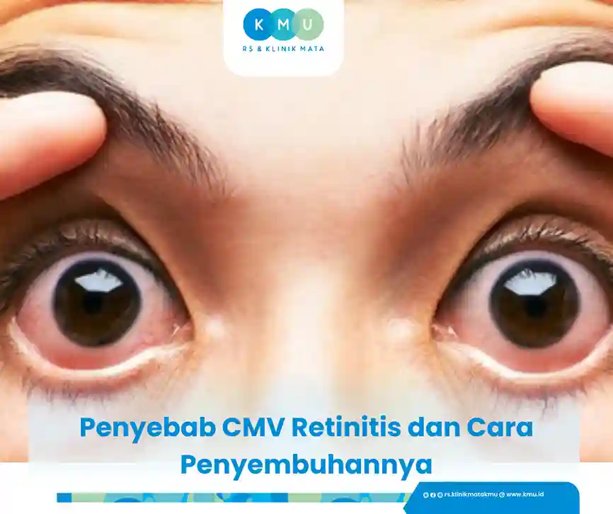 penyebab cmv retinitis dan cara penyembuhannya