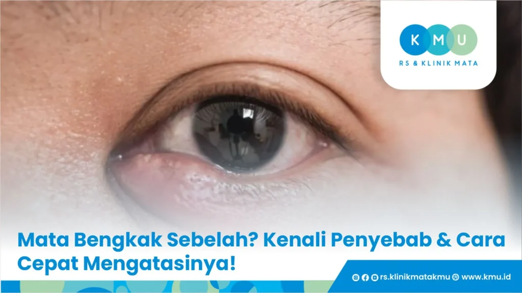 Mata Bengkak Sebelah? Kenali Penyebab & Cara Cepat Mengatasinya!