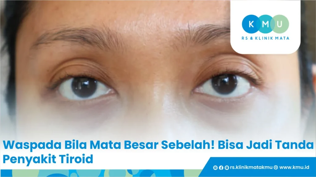 Waspada Bila Mata Besar Sebelah! Bisa Jadi Tanda Penyakit Tiroid