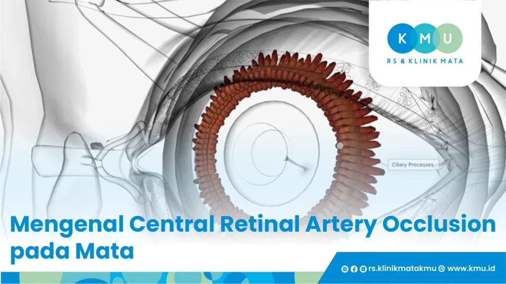 Mengenal Central Retinal Artery Occlusion pada Mata
