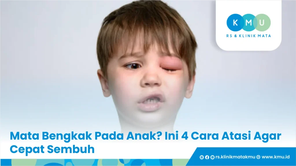 Mata Bengkak Pada Anak? Ini 4 Cara Atasi Agar Cepat Sembuh