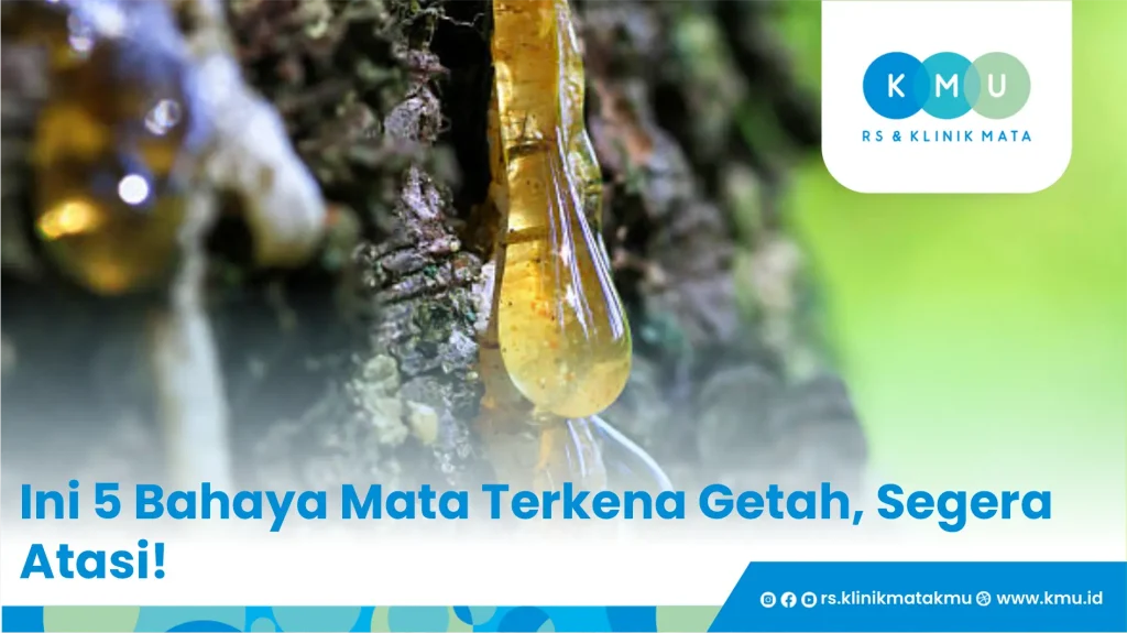 Ini 5 Bahaya Mata Terkena Getah, Segera Atasi!