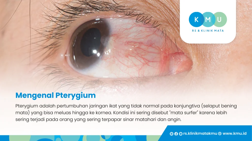 Mengenal Pterygium - Pengobatan Pterygium