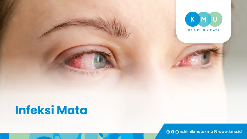 Infeksi atau Konjungtivitis - Mata Tiba-Tiba Bengkak