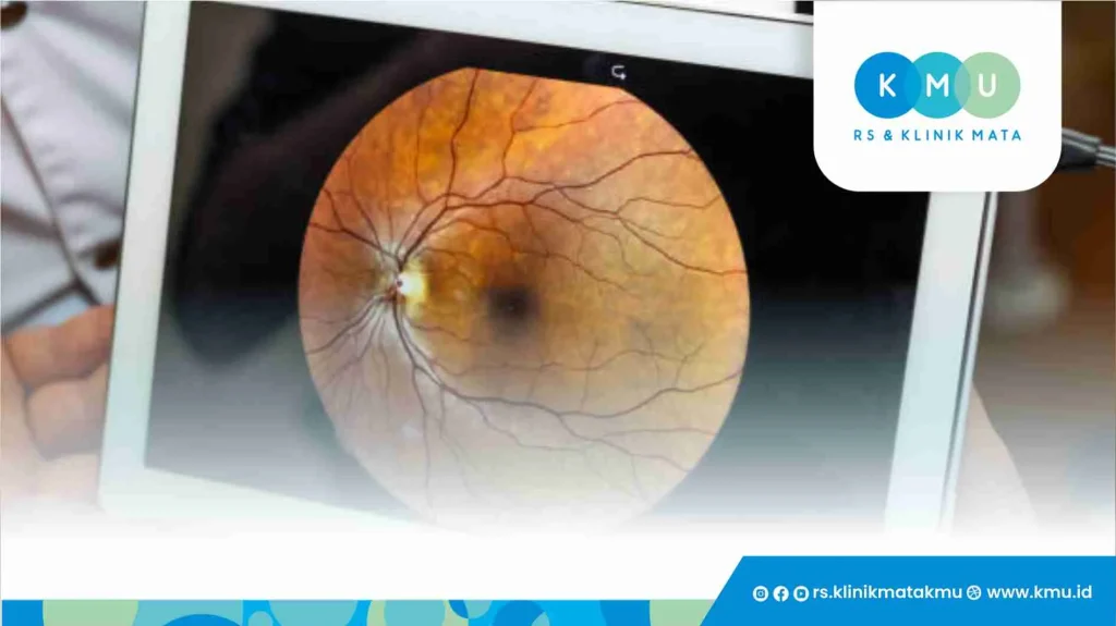 Apa Itu Operasi Retina Mata?
