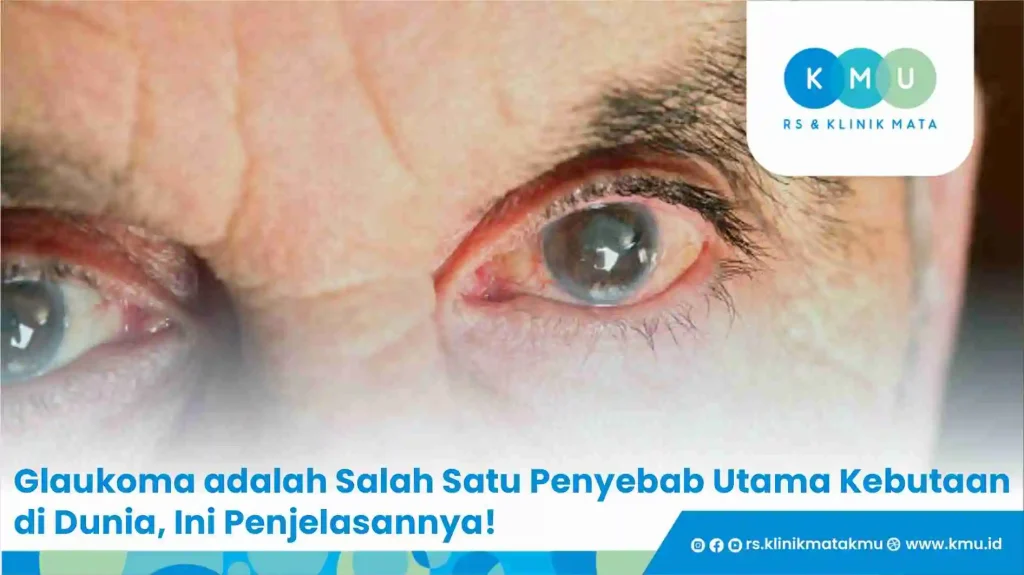 Glaukoma adalah Salah Satu Penyebab Utama Kebutaan di Dunia, Ini Penjelasannya!