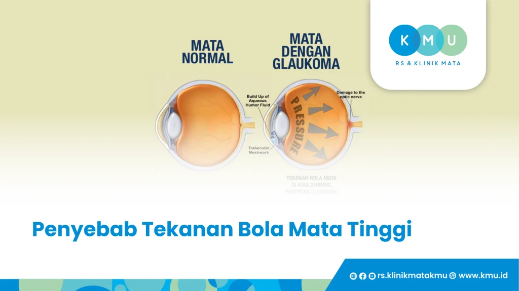 Penyebab Tekanan Bola Mata Tinggi