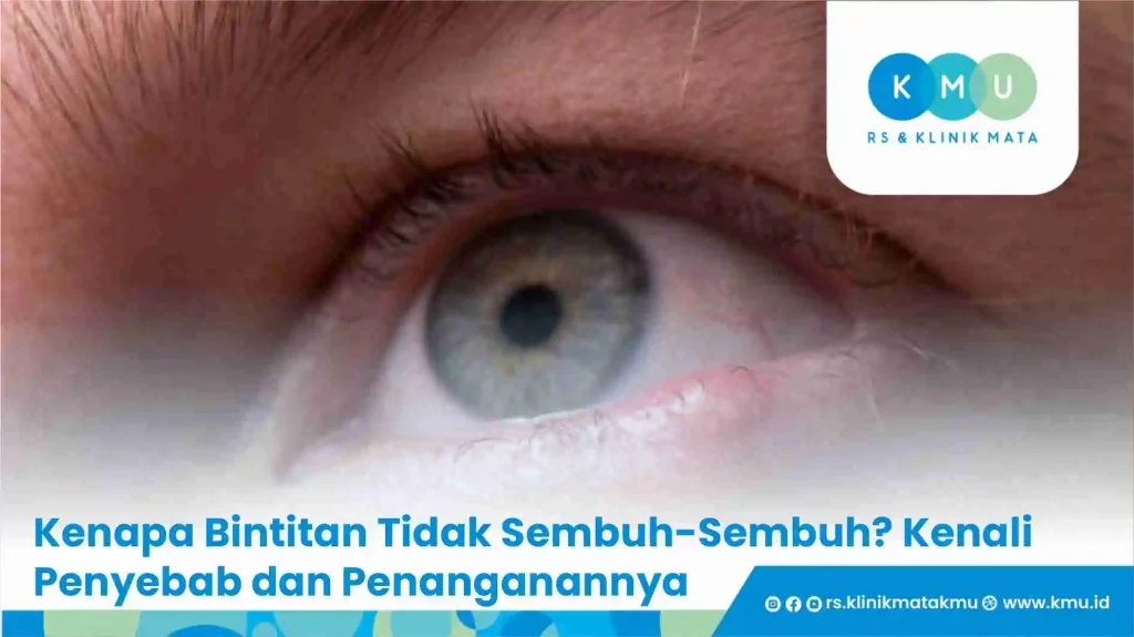 Kenapa Bintitan Tidak Sembuh-Sembuh? Kenali Penyebab dan Penanganannya