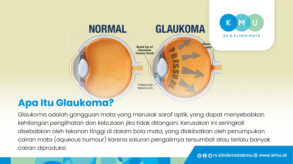Apa itu glaukoma - Gambar mata glaukoma