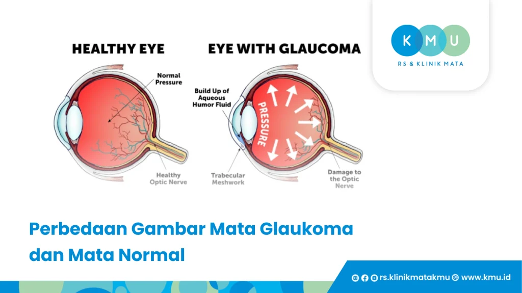 Perbedaan Gambar Mata Glaukoma dan Mata Normal