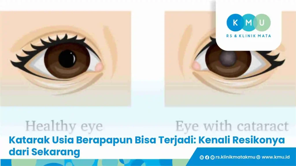 Katarak Usia Berapapun Bisa Terjadi: Kenali Resikonya dari Sekarang