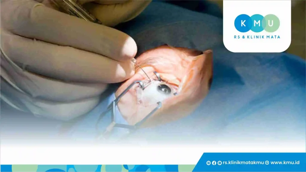 Solusi Katarak dengan Operasi Lensa Premium