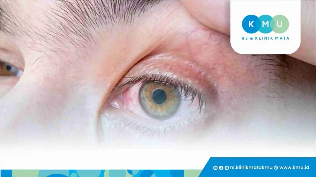 Memahami Fotokeratitis: Kondisi Mata Terbakar Sinar UV
