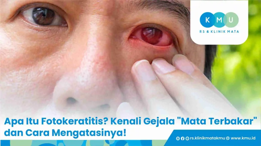 Apa Itu Fotokeratitis? Kenali Gejala "Mata Terbakar" dan Cara Mengatasinya!