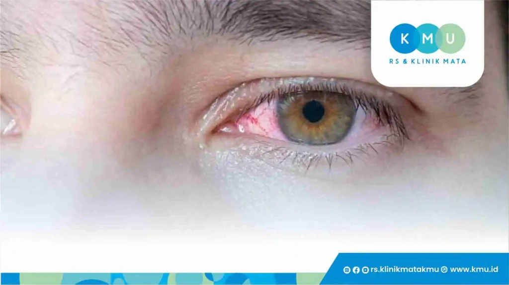 Penyebab Utama Fotokeratitis