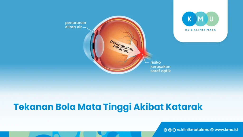 Tekanan Bola Mata Tinggi Akibat Katarak - Nyeri Mata
