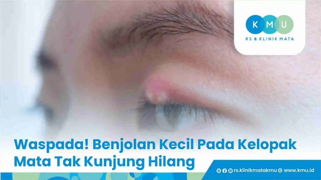 Waspada! Benjolan Kecil Pada Kelopak Mata Tak Kunjung Hilang
