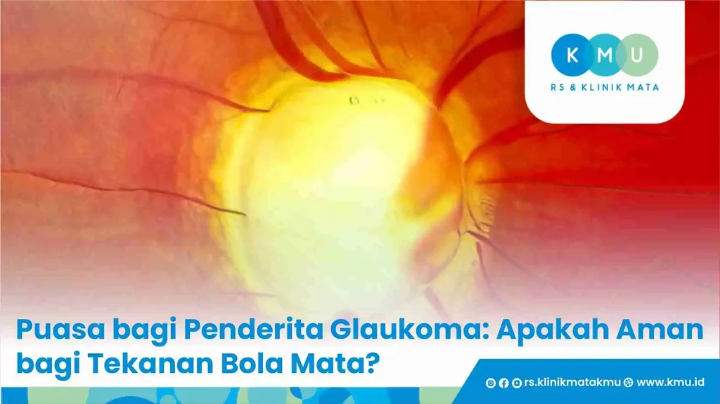 Puasa bagi Penderita Glaukoma: Apakah Aman bagi Tekanan Bola Mata?