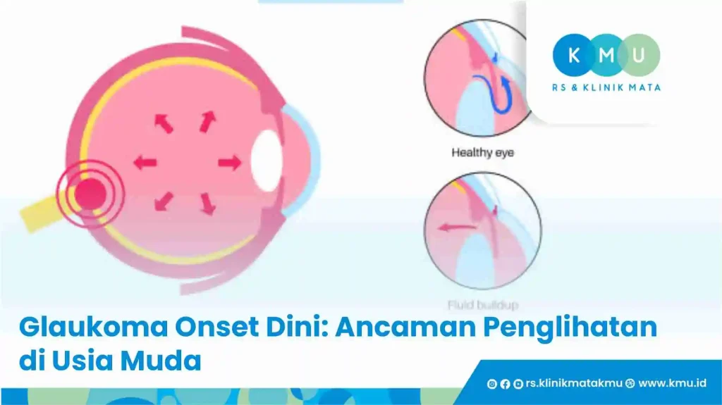Glaukoma Onset Dini: Ancaman Penglihatan di Usia Muda