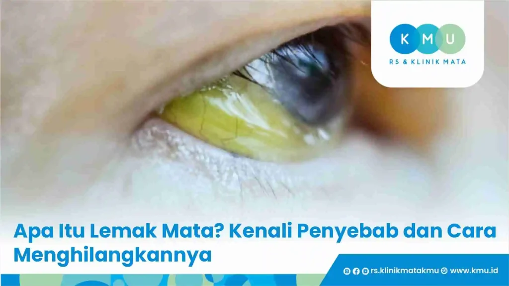 Apa Itu Lemak Mata? Kenali Penyebab dan Cara Menghilangkannya