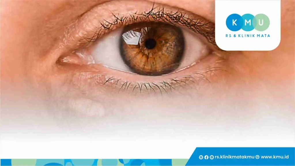 Xanthelasma