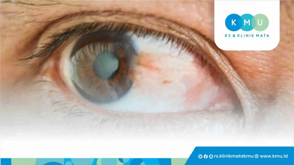 Pterygium